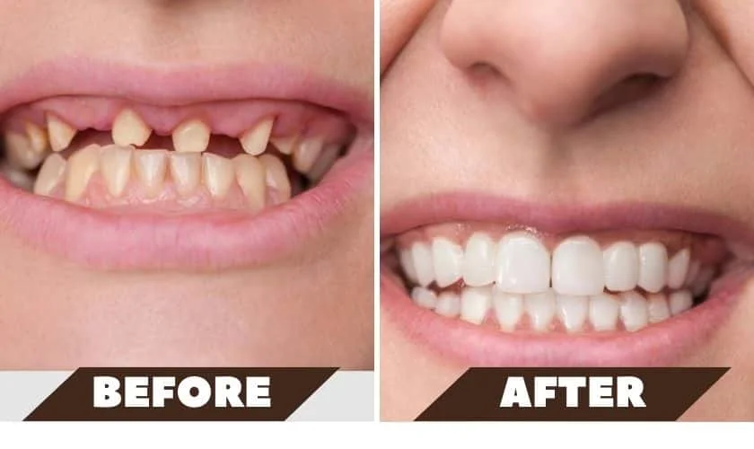 Dental before and after smile teeth transformation
