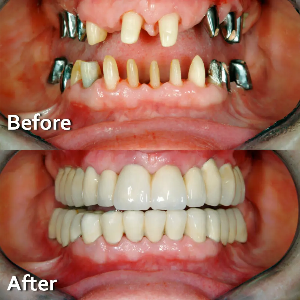 Dental Implant Marketing and High Value Patient Acquisition framework